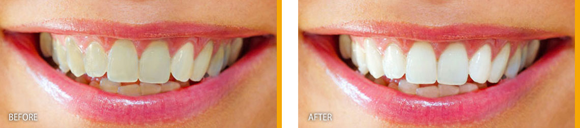 Teeth Whitening Treatment Before & After Results - East Gwillimbury, ON