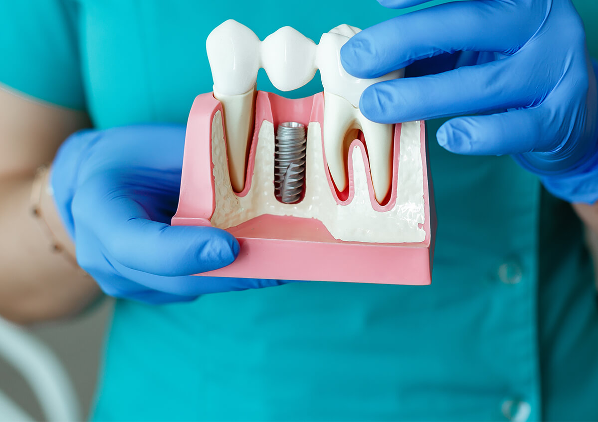 Teeth Implants Dentist in East Gwillimbury ON Area